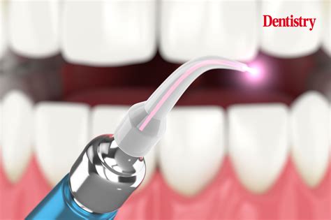 portland laser dentistry|Laser Dentistry .